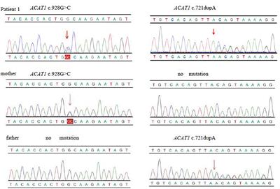 Two Infants With Beta-Ketothiolase Deficiency Identified by Newborn Screening in China